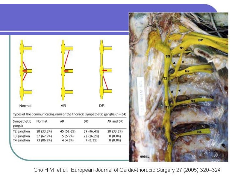 Diapositiva 15 de Simpatectomía Torácica