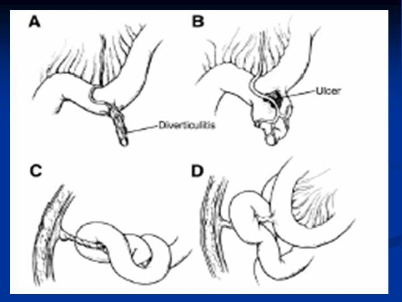 Diapositiva 11 de Divertículo de Meckel