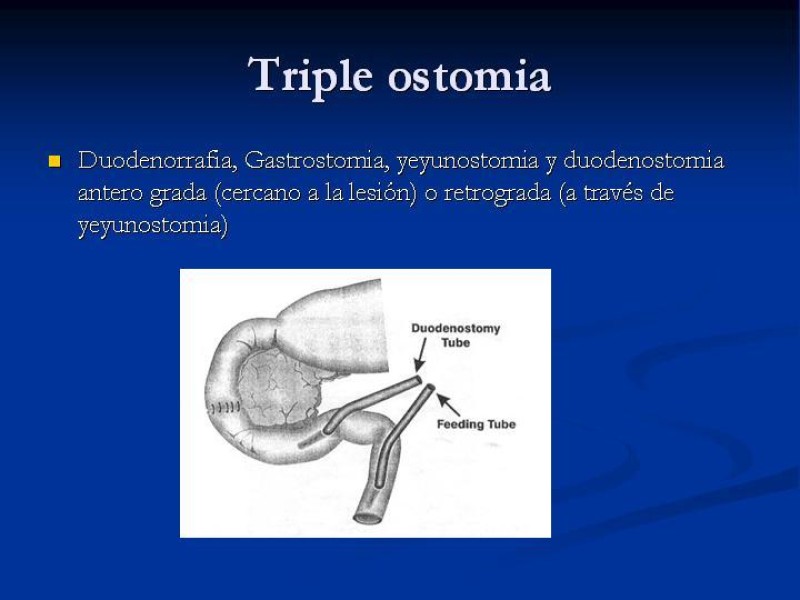 Diapositiva 34 de Trauma Pancreato-duodenal