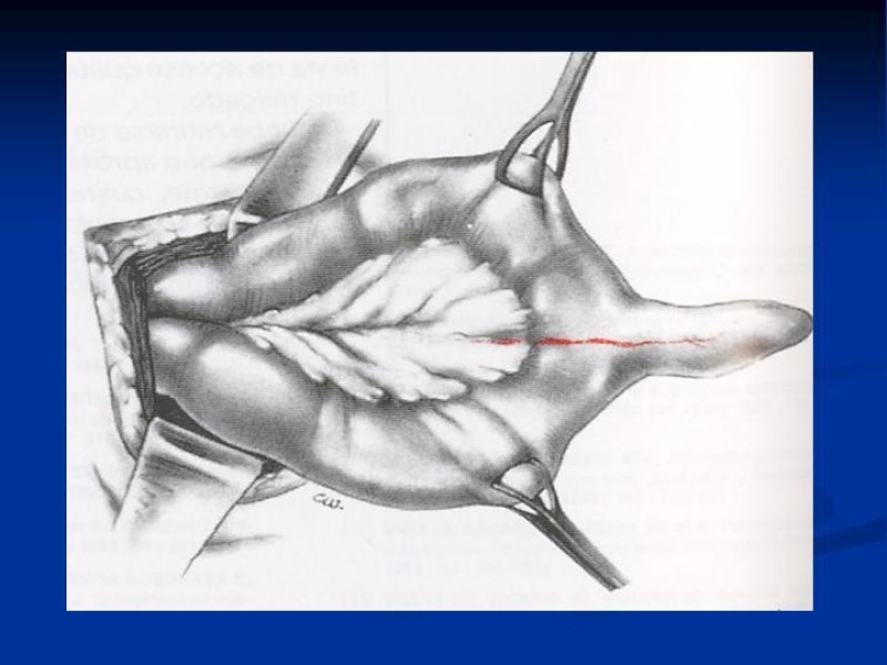 Diapositiva 19 de Divertículo de Meckel