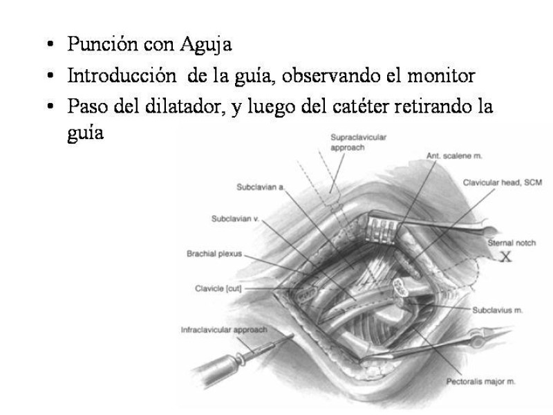 Diapositiva 10 de Catéter de Quimioterapia