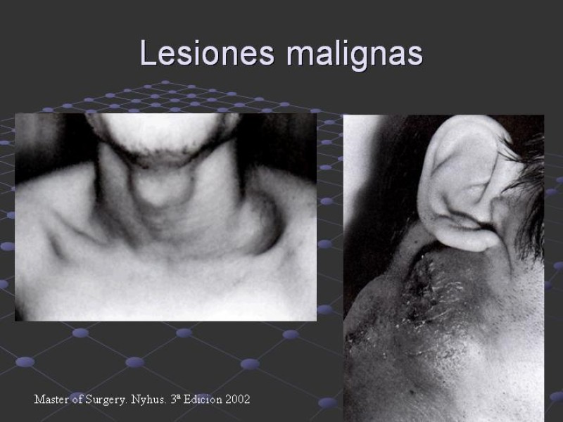 Diapositiva 8 de Estudio de Masas Cervicales