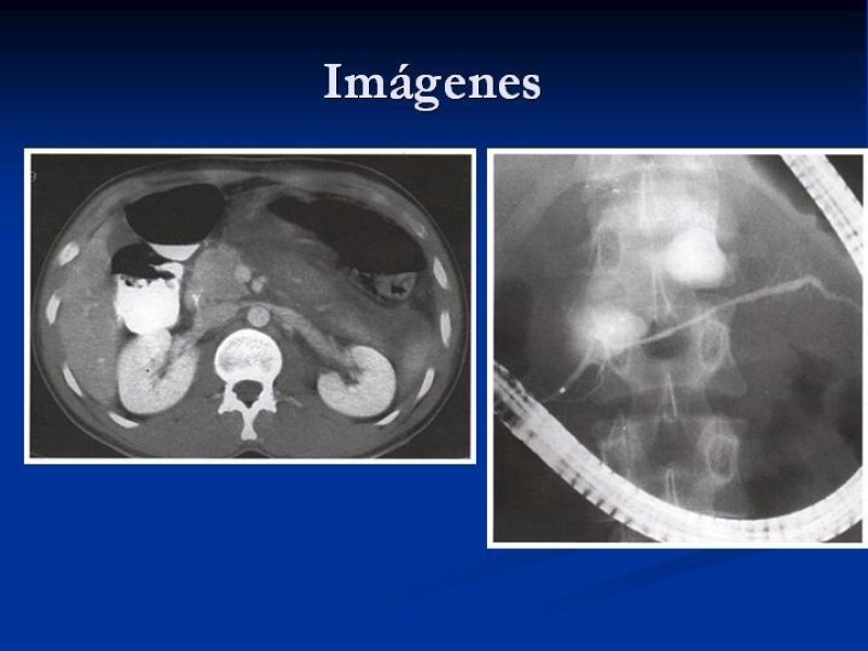 Diapositiva 15 de Trauma Pancreato-duodenal