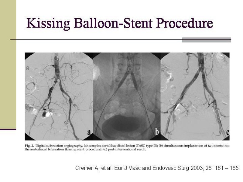Diapositiva 16 de Tratamiento Endovascular de la Enfermedad Aortoilíaca