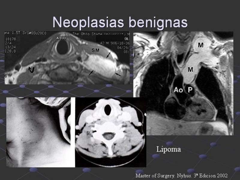 Diapositiva 28 de Estudio de Masas Cervicales