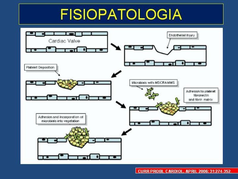 Diapositiva 5 de Endocarditis Infecciosa