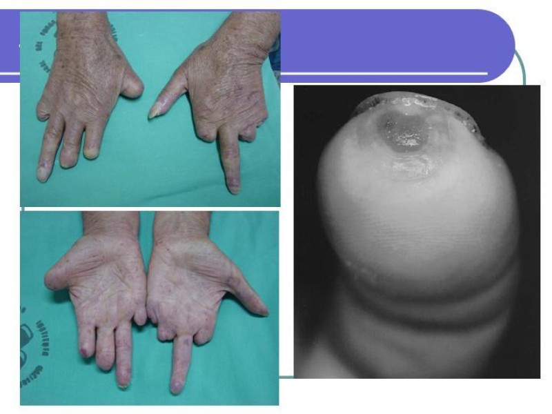 Diapositiva 9 de Simpatectomía Torácica