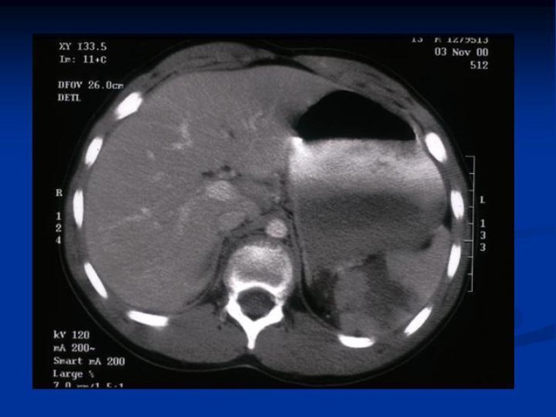 Diapositiva 7 de Trauma Esplénico