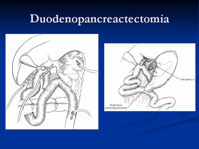 Diapositiva 39 de Trauma Pancreato-duodenal