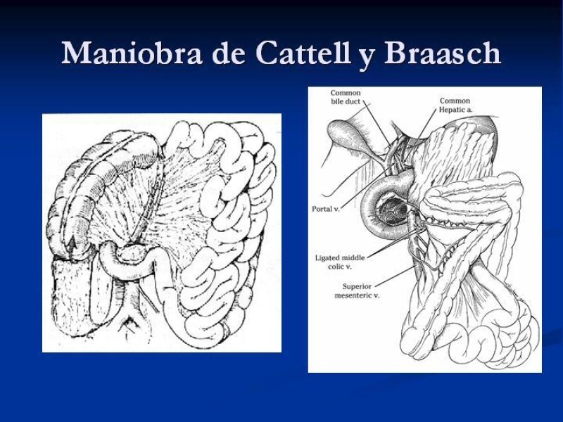 Diapositiva 25 de Trauma Pancreato-duodenal