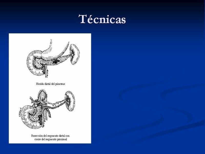 Diapositiva 46 de Trauma Pancreato-duodenal