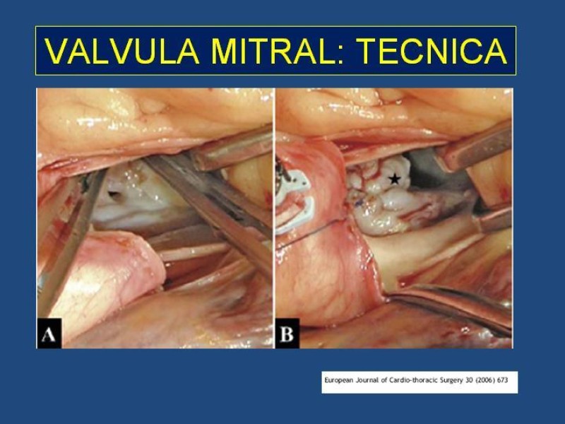 Diapositiva 24 de Endocarditis Infecciosa