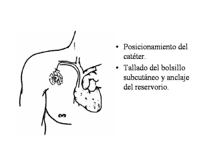 Diapositiva 11 de Catéter de Quimioterapia