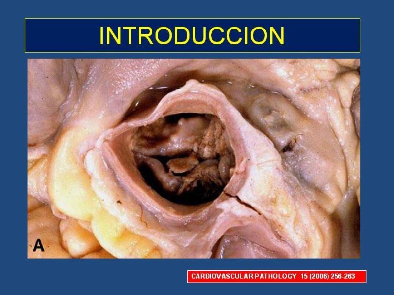 Diapositiva 1 de Endocarditis Infecciosa