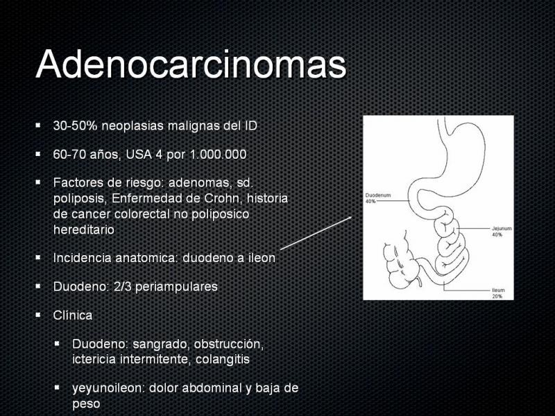 Diapositiva 15 de Tumores de Intestino Delgado