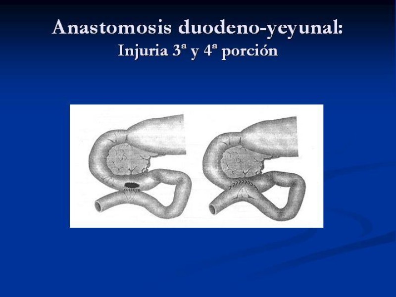 Diapositiva 35 de Trauma Pancreato-duodenal