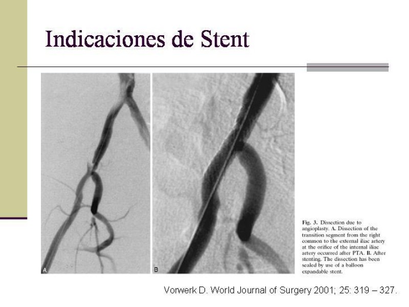 Diapositiva 27 de Tratamiento Endovascular de la Enfermedad Aortoilíaca