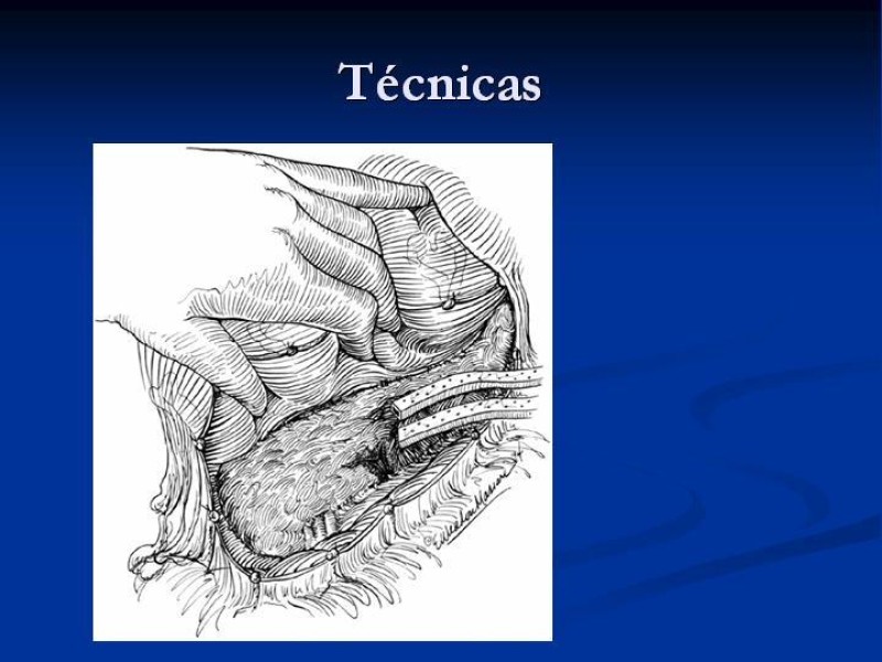 Diapositiva 44 de Trauma Pancreato-duodenal