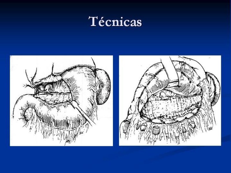 Diapositiva 28 de Trauma Pancreato-duodenal