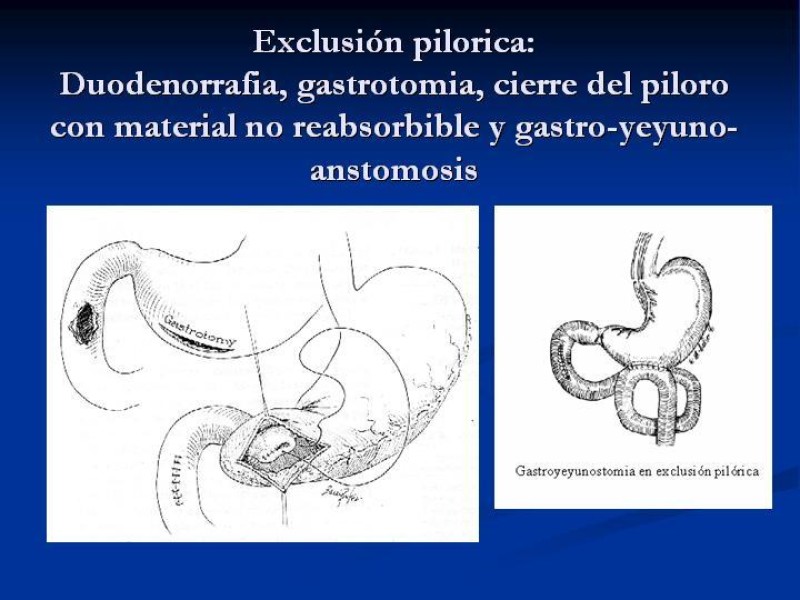 Diapositiva 37 de Trauma Pancreato-duodenal