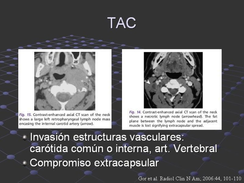 Diapositiva 22 de Estudio de Masas Cervicales