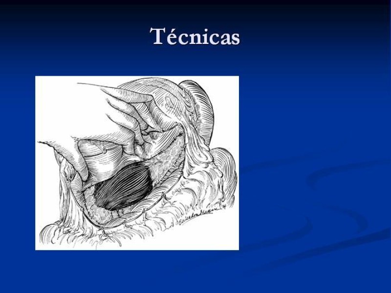 Diapositiva 29 de Trauma Pancreato-duodenal
