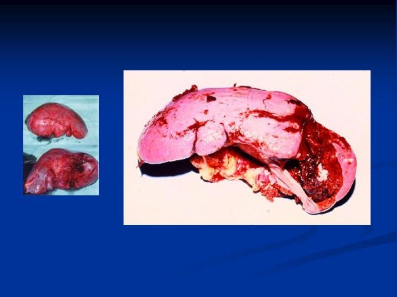 Diapositiva 1 de Trauma Esplénico