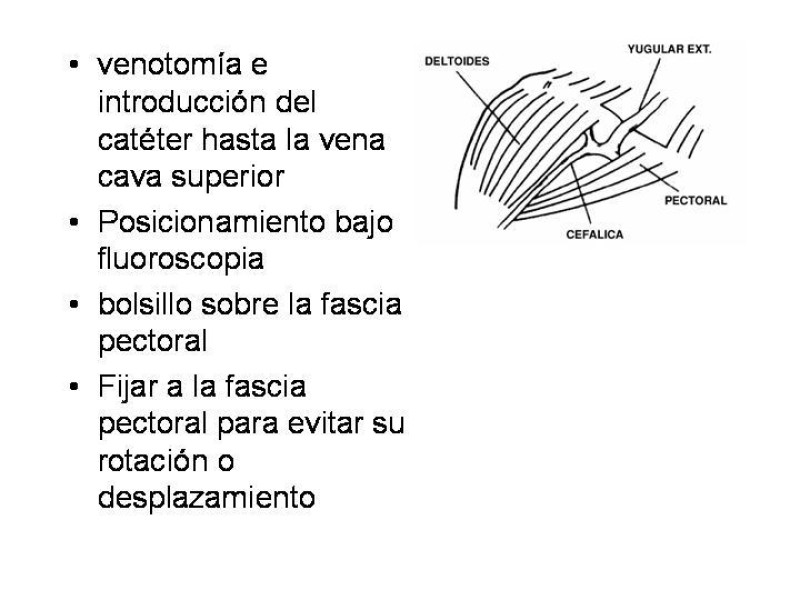 Diapositiva 6 de Catéter de Quimioterapia