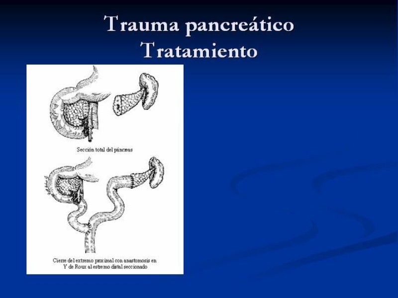 Diapositiva 48 de Trauma Pancreato-duodenal