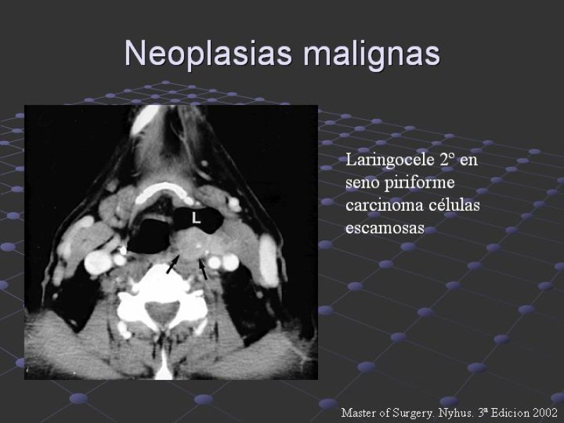 Diapositiva 26 de Estudio de Masas Cervicales