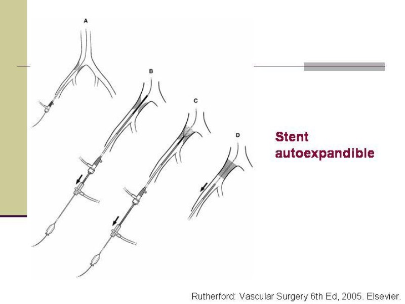 Diapositiva 30 de Tratamiento Endovascular de la Enfermedad Aortoilíaca