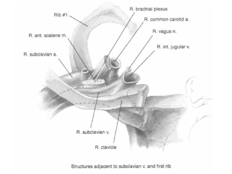 Diapositiva 8 de Catéter de Quimioterapia
