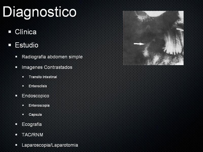 Diapositiva 9 de Tumores de Intestino Delgado