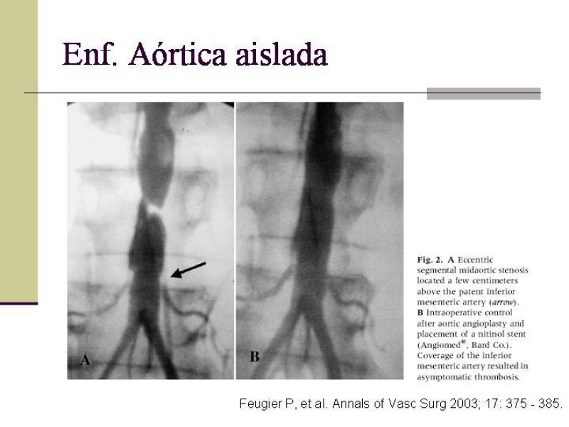 Diapositiva 17 de Tratamiento Endovascular de la Enfermedad Aortoilíaca