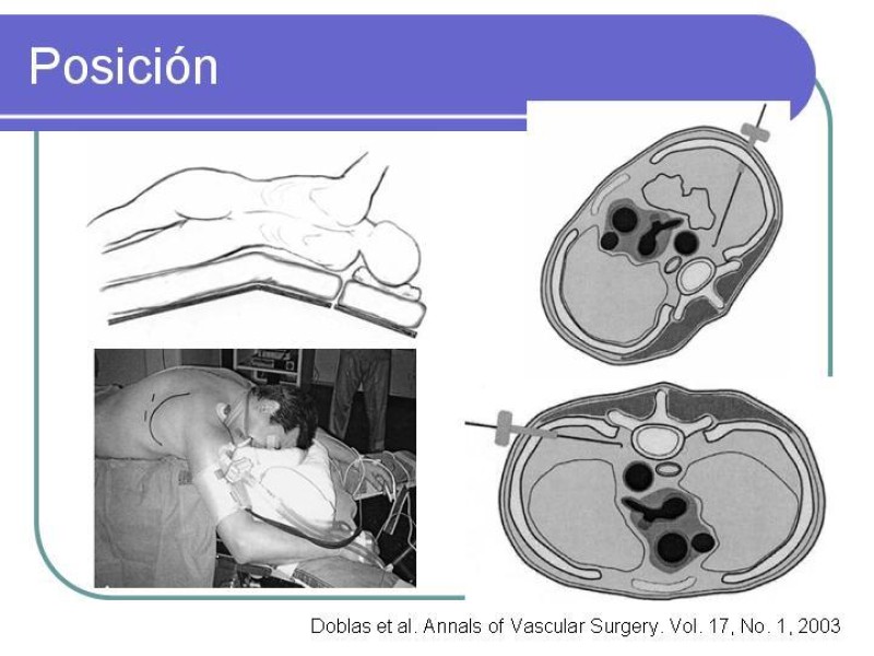 Diapositiva 16 de Simpatectomía Torácica