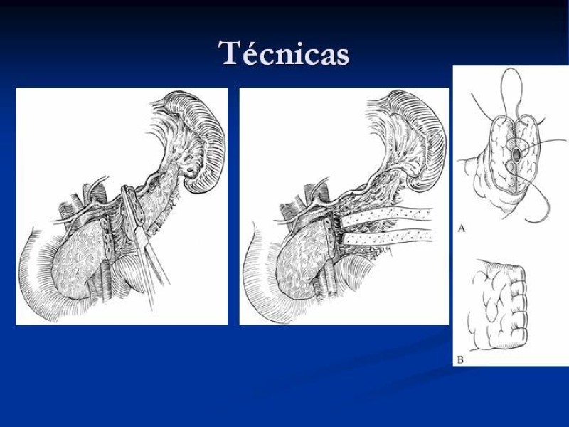 Diapositiva 45 de Trauma Pancreato-duodenal