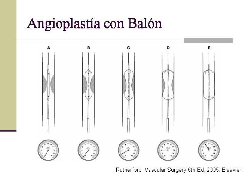 Diapositiva 19 de Tratamiento Endovascular de la Enfermedad Aortoilíaca