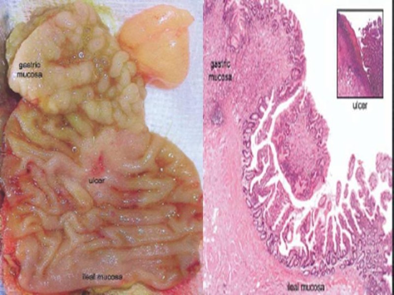 Diapositiva 8 de Divertículo de Meckel