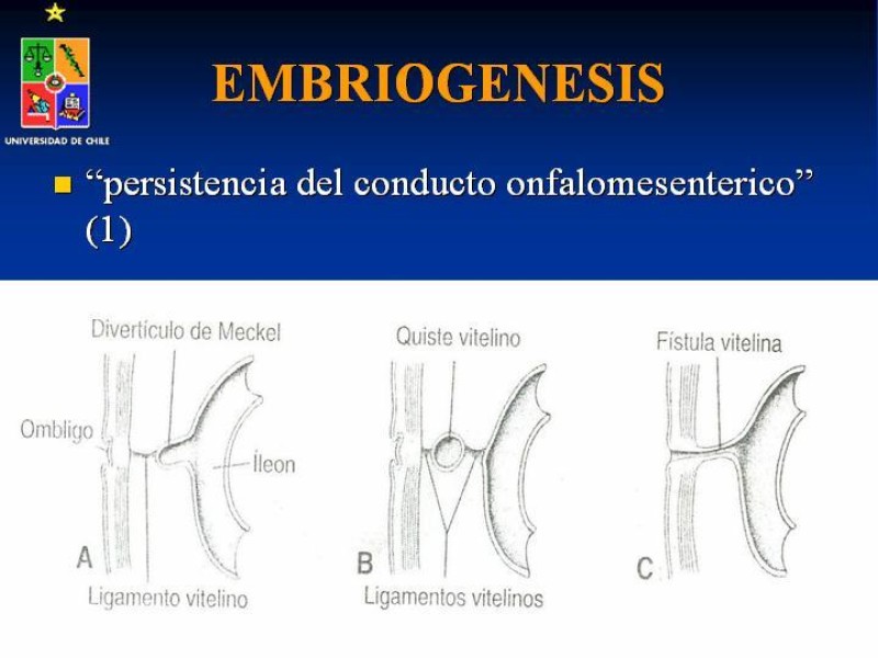 Diapositiva 1 de Divertículo de Meckel