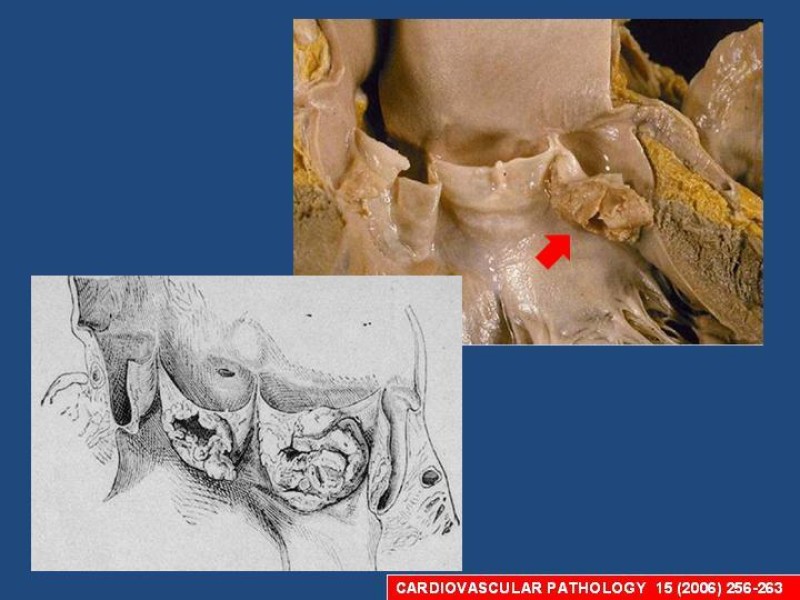 Diapositiva 14 de Endocarditis Infecciosa