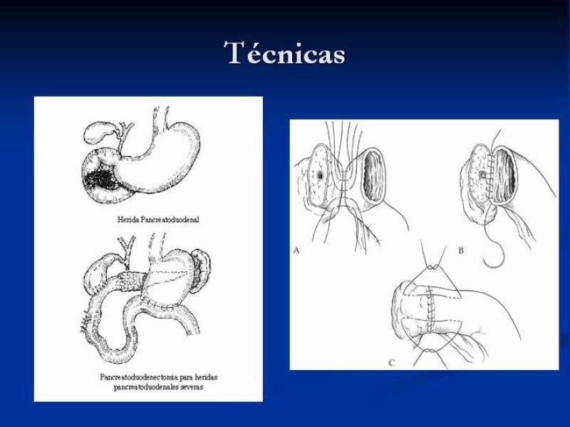 Diapositiva 47 de Trauma Pancreato-duodenal