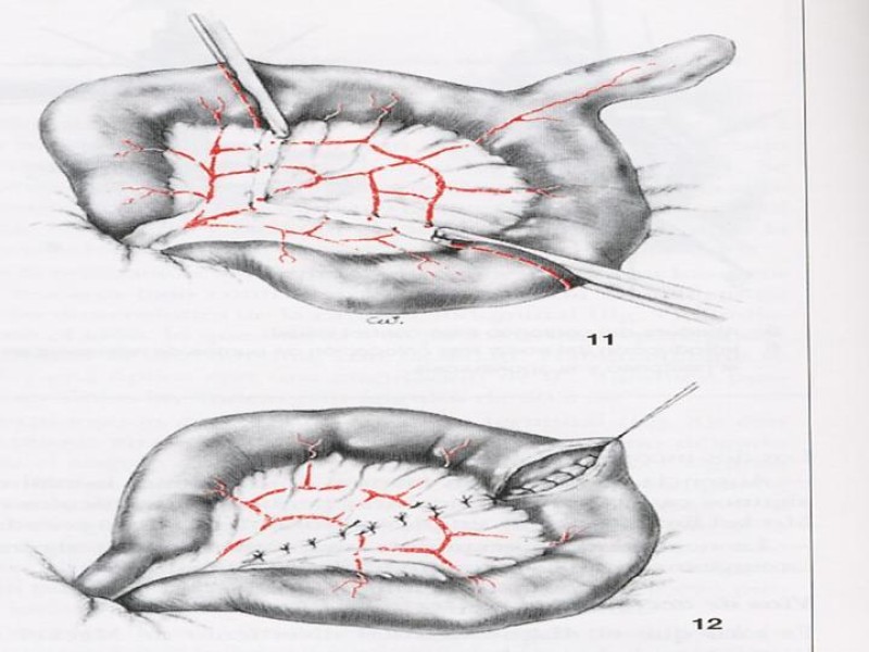 Diapositiva 29 de Divertículo de Meckel