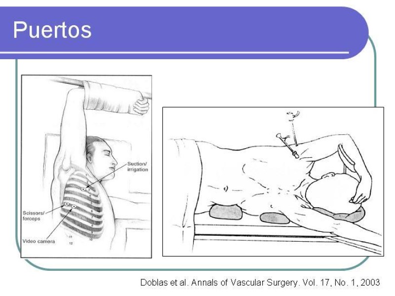 Diapositiva 17 de Simpatectomía Torácica