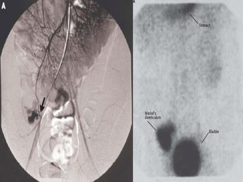 Diapositiva 16 de Divertículo de Meckel