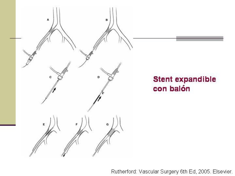 Diapositiva 29 de Tratamiento Endovascular de la Enfermedad Aortoilíaca