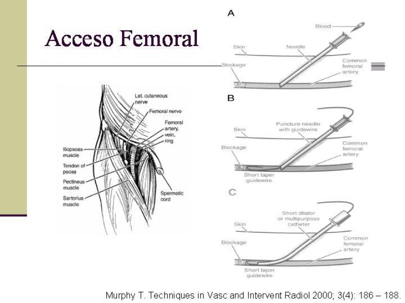 Diapositiva 14 de Tratamiento Endovascular de la Enfermedad Aortoilíaca