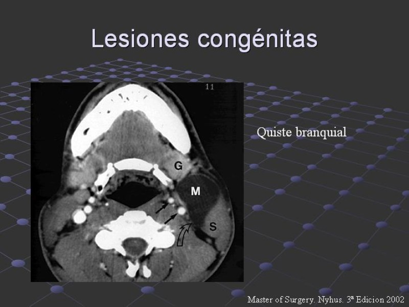 Diapositiva 24 de Estudio de Masas Cervicales
