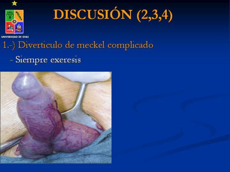 Diapositiva 35 de Divertículo de Meckel