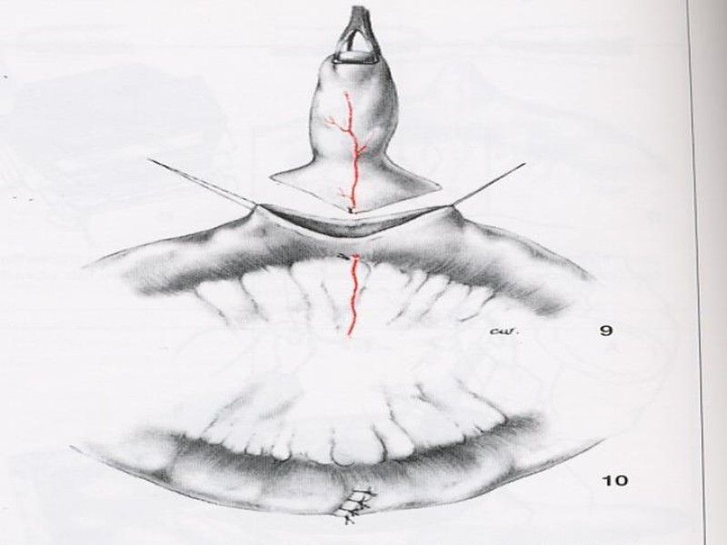 Diapositiva 27 de Divertículo de Meckel