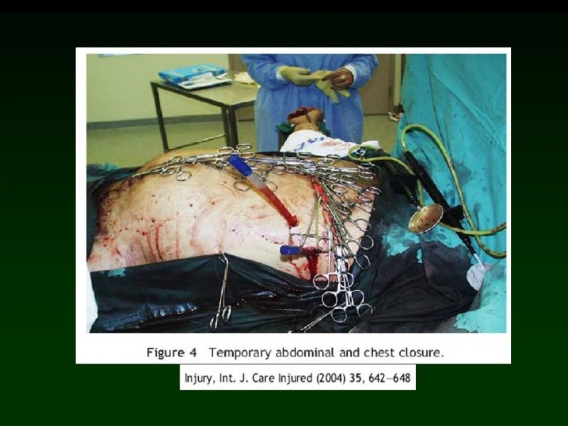 Diapositiva 32 de Trauma: Damage Control